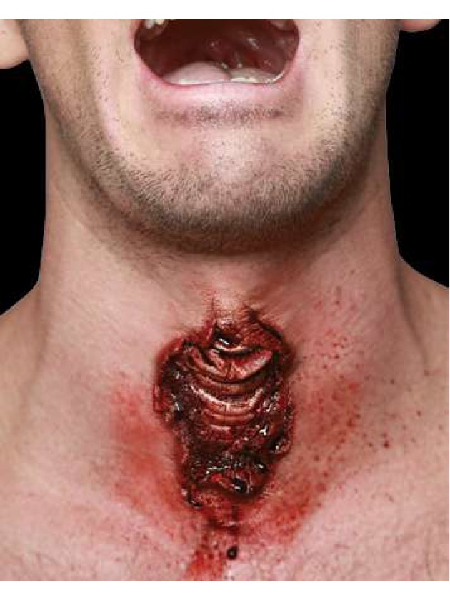 CICATRICE LATEX PLAIE GORGE TRACHEOTOMIE 