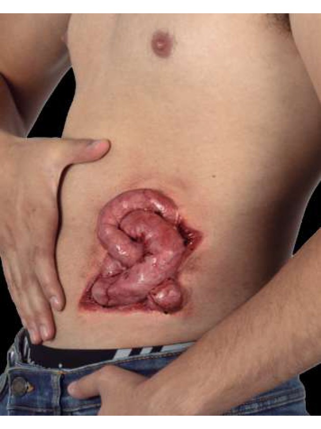 INTESTINE WOUND 